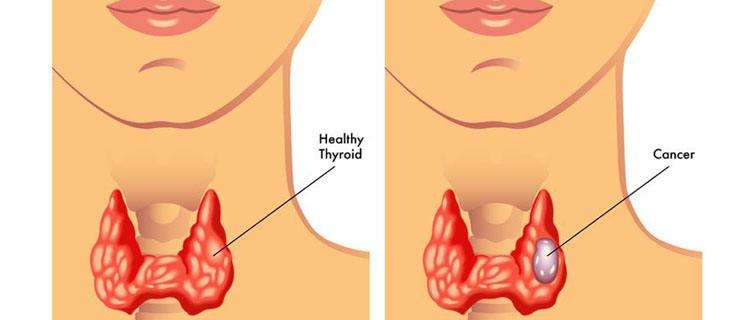 甲状腺结节会癌变的几种情况
